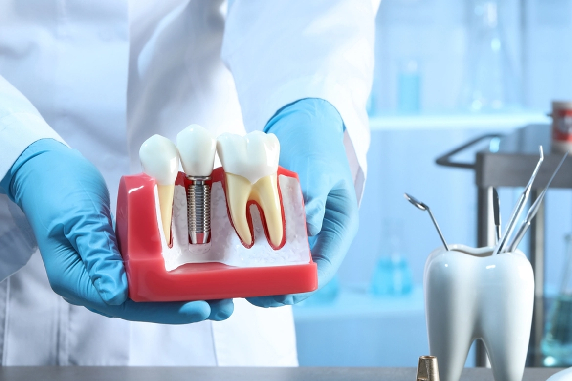 Dental Implant | Case Study