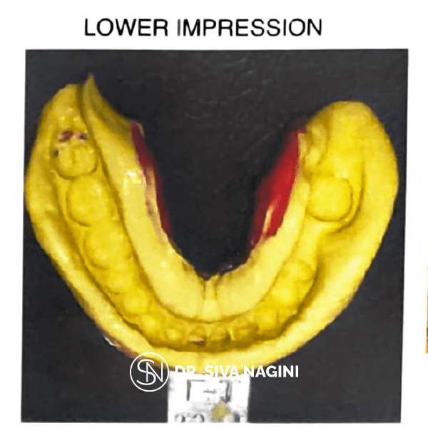 Lower Impression