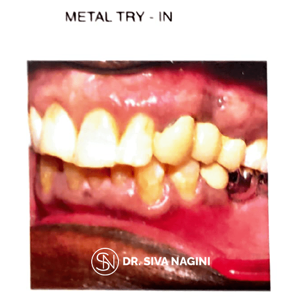 Metal Try-In