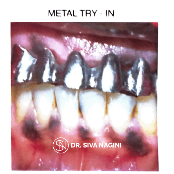 Metal Try-In