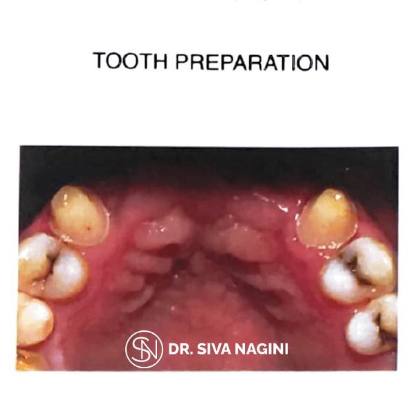 Tooth Preparation