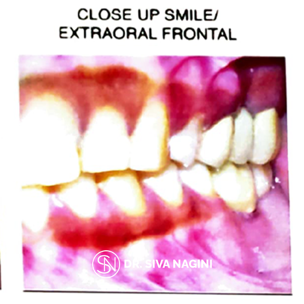 Close up Smile/Extraoral Frontal