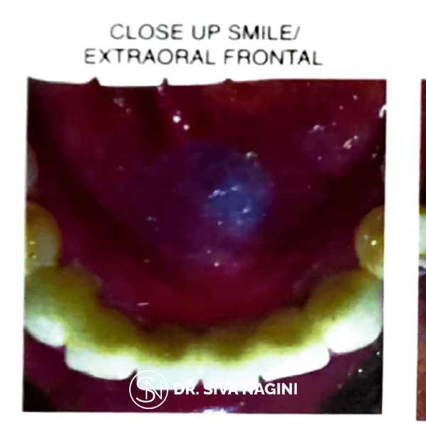 Close up Smile/ Extraoral Frontal