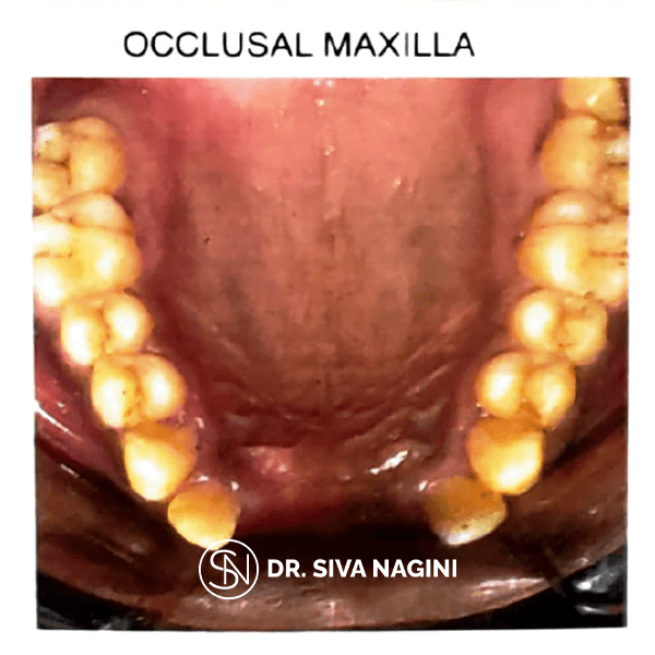 Occlusal Maxilla