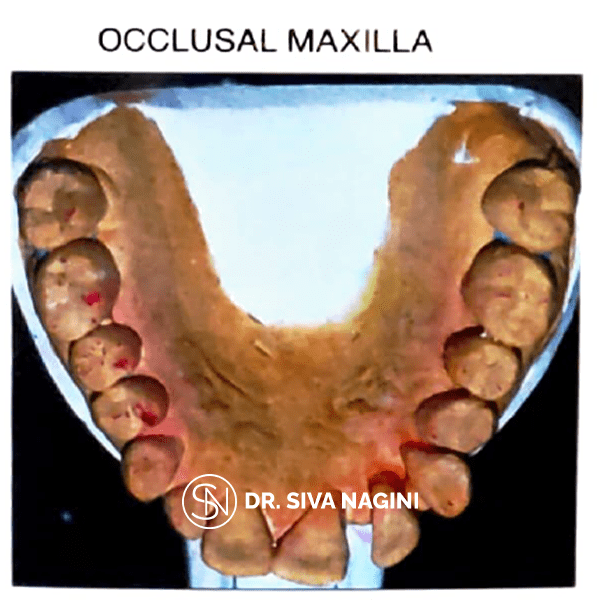 Occlusal Maxilla