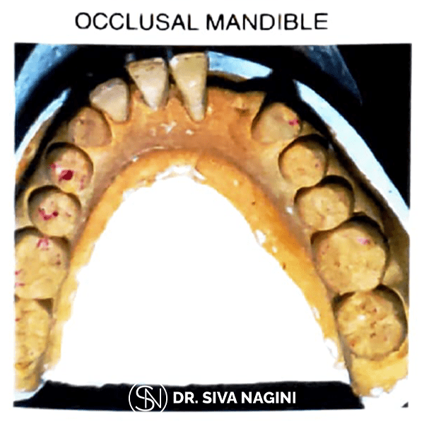 Occlusal Mandible