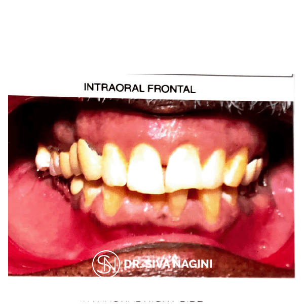 Intraoral Frontal