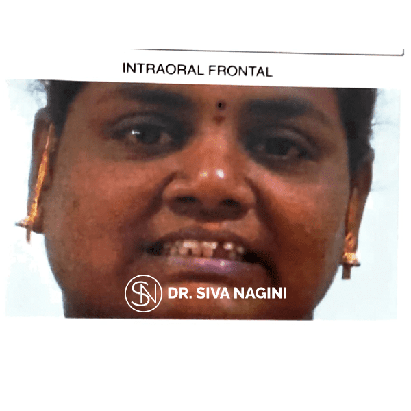 Intraoral Frontal