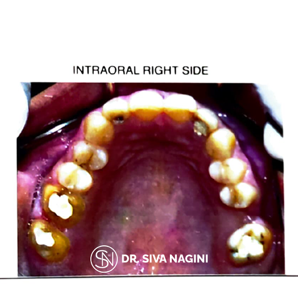 Intraoral Right Side