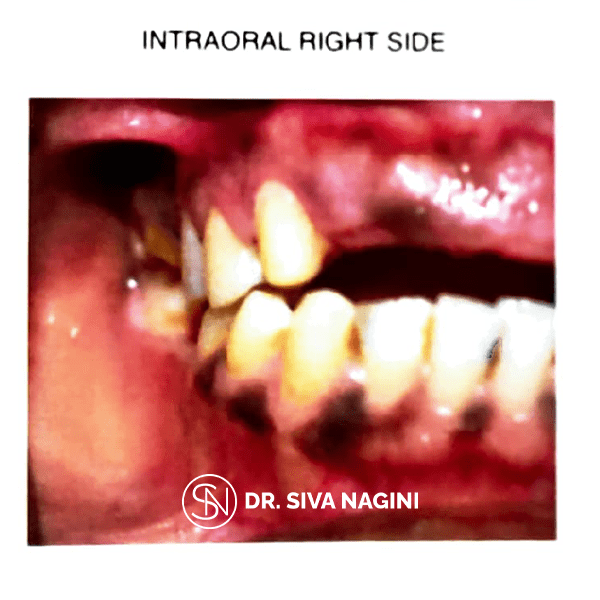Intraoral Right Side