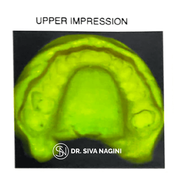 Upper Impression