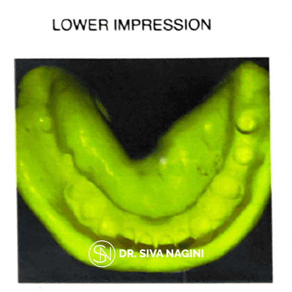 Lower Impression