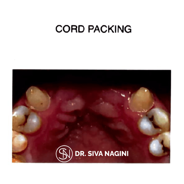 Cord Packing