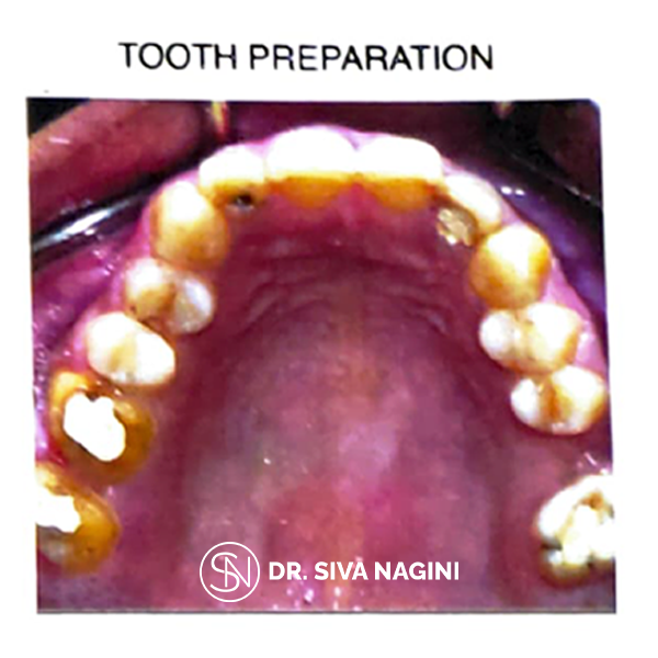Tooth Preparation