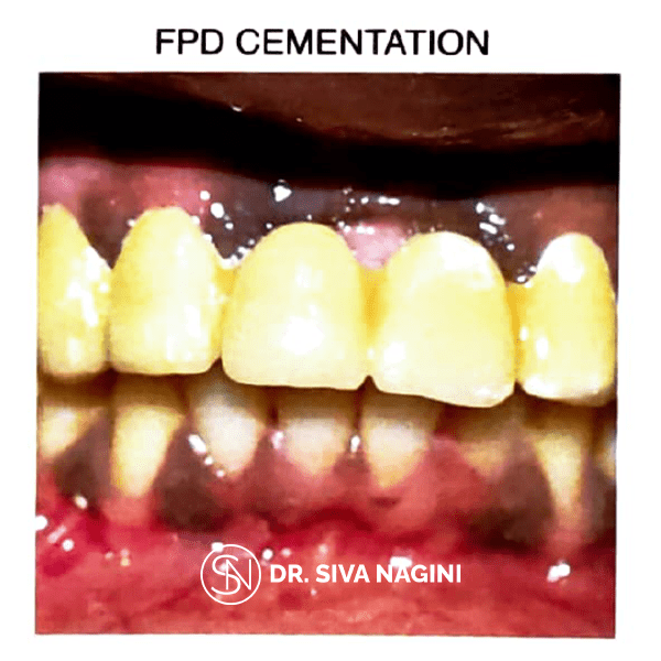 FPD Cementation